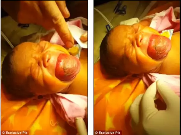 Boy Born With Giant Tongue Finally Undergoes Surgery. See New Photos